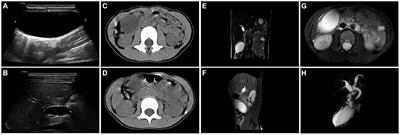 Case report: Rare floating gallbladder torsion in a child